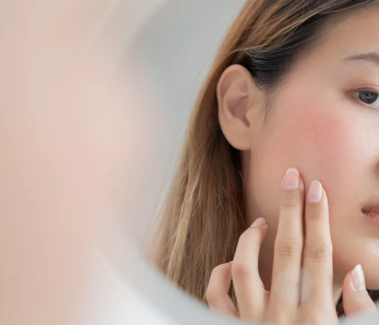 Don’t Let Rosacea Dim Your Glow: Proven Strategies for Managing Flare-Ups