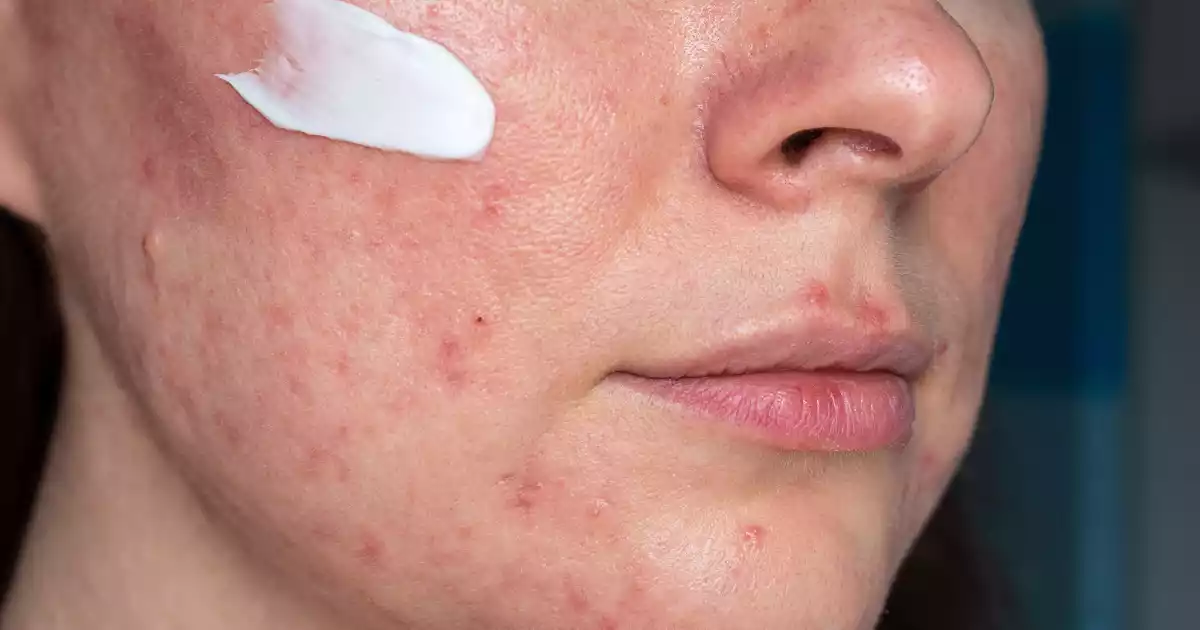 woman with rosacea and cream on her face